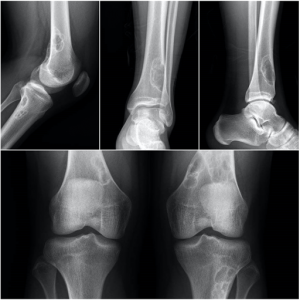 Fibroma no osificante Traumatólogo Granada Dr Eugenio Díaz
