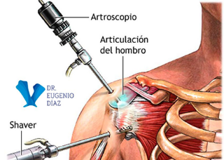 Artroscopia de Hombro Manguito Rotador Traumatólogo Granada Dr Eugenio Díaz