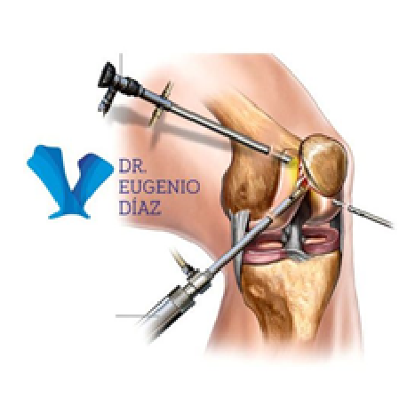 Artroscopia de rodilla. Traumatólogo Granada. Dr.Eugenio Díaz