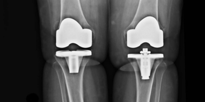 Prótesis de Rodilla. Traumatólogo en Granada. Dr. Eugenio Díaz