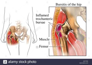 Trocanteritis Bursitis cadera Traumatologo Granada